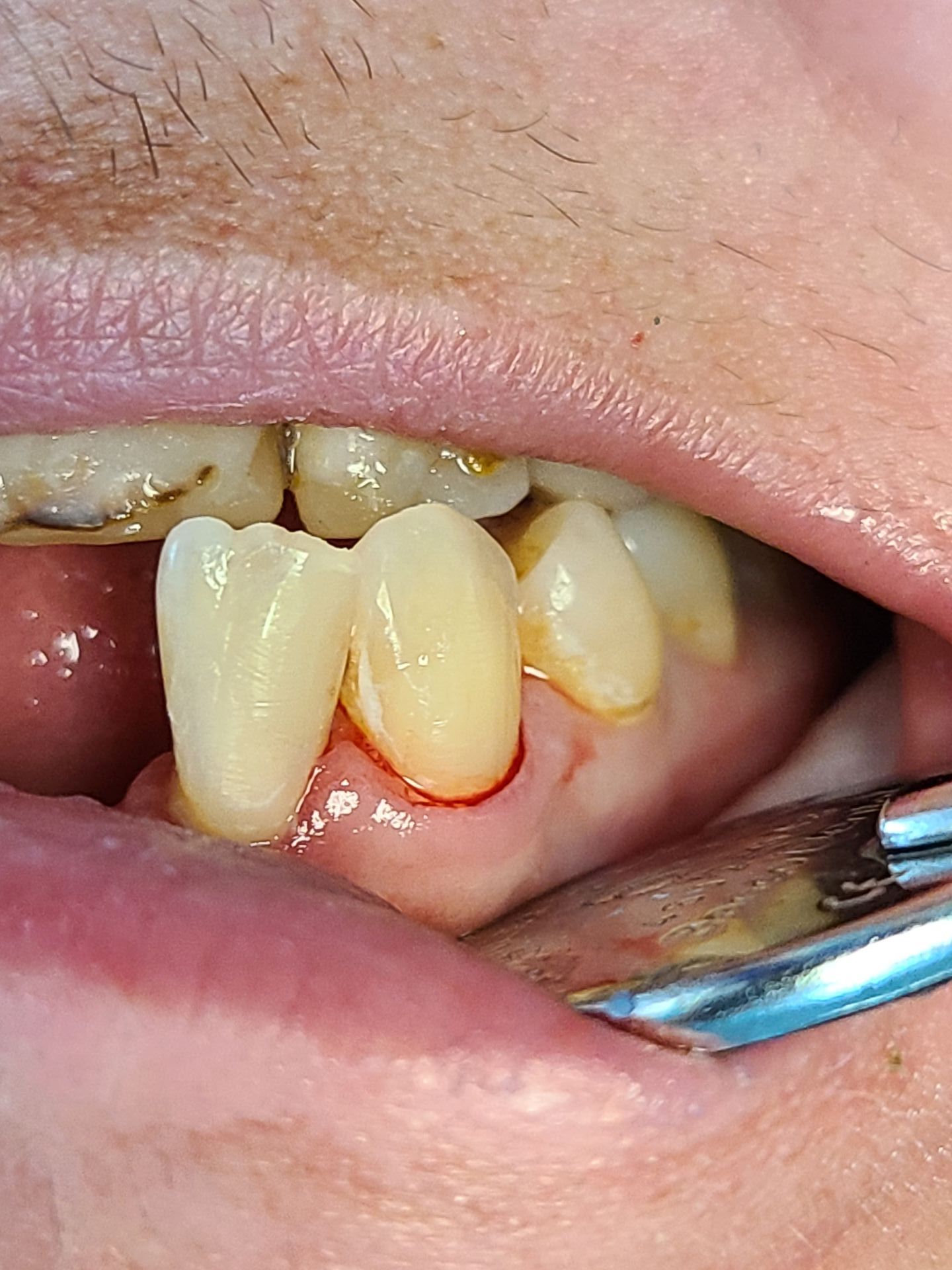 composite-bonding-2-lower-teeth-after-1920w