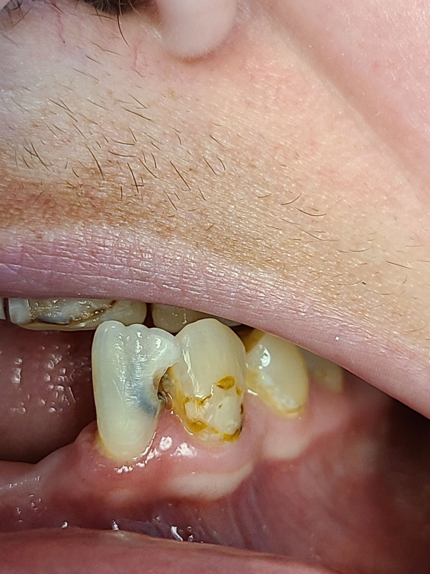 composite-bonding-2-lower-teeth-before-1920w