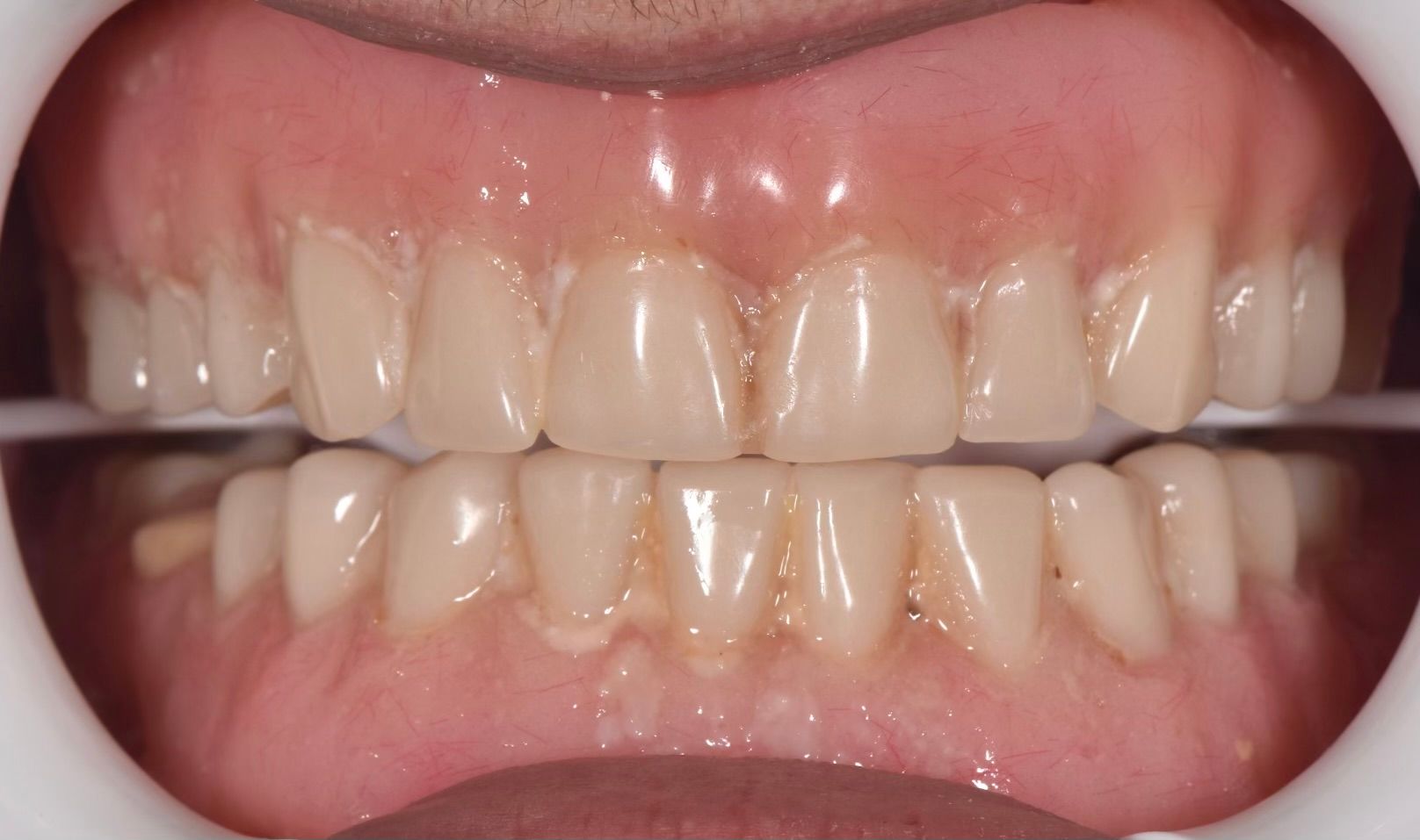 denture+before-1920w